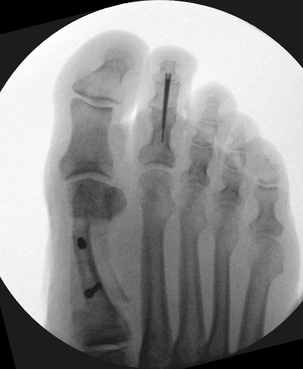 X-ray taken after bunion surgery