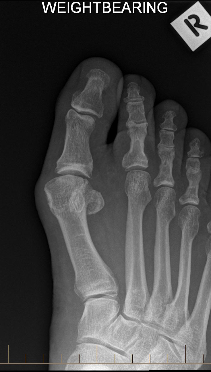 X-ray taken before bunion surgery