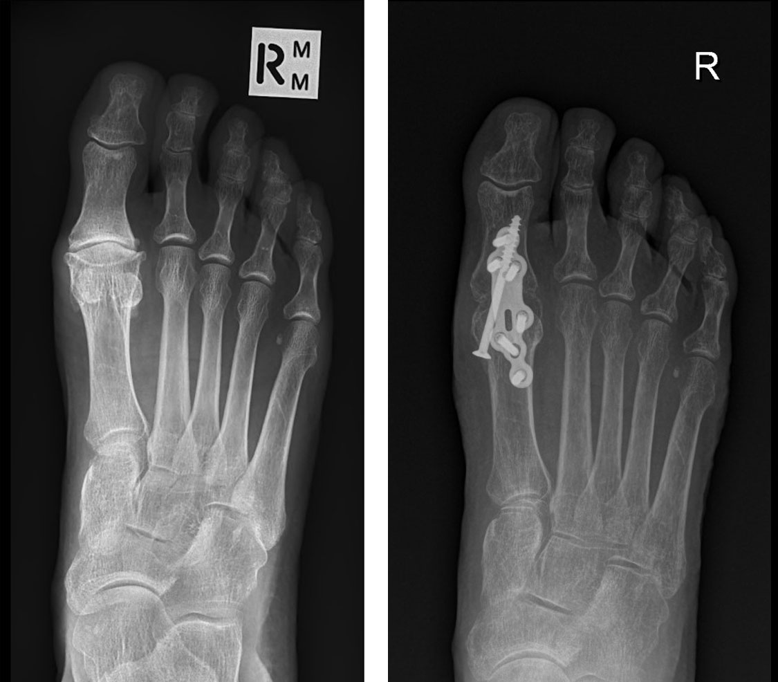 X-rays taken before and after great toe fusion surgery