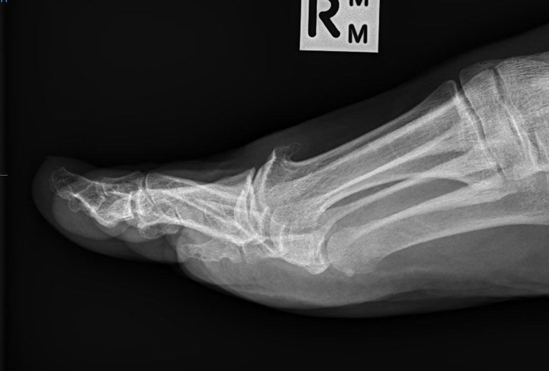 X-ray taken before great toe fusion surgery